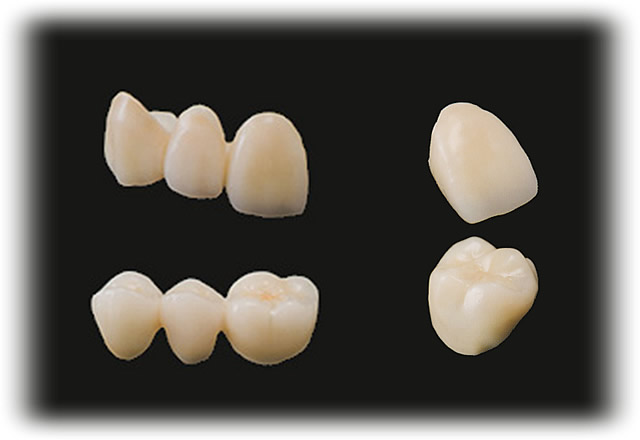 審美的な「被せ物・詰め物」