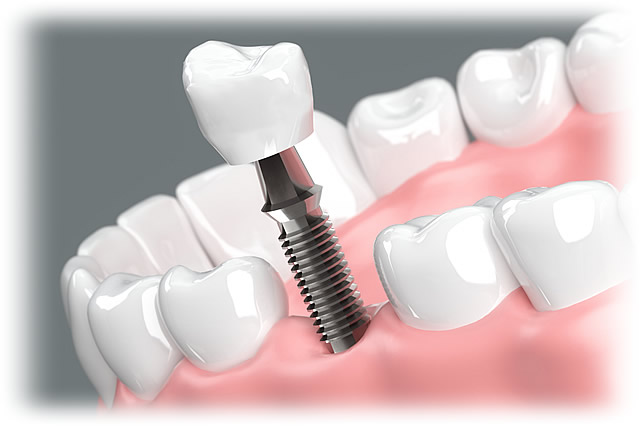インプラント治療