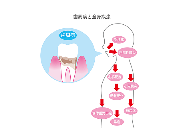 歯周病と全身疾患